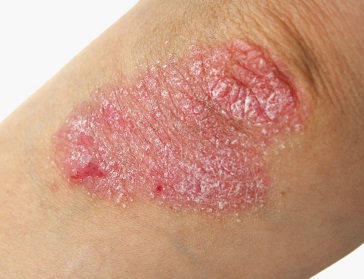 psoriasis1