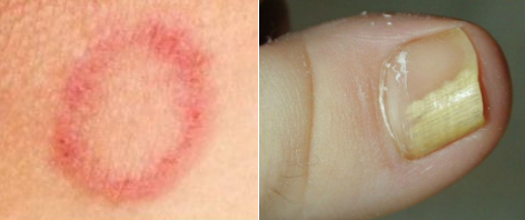 Tinea1
